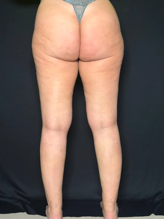 Depois do tratamento — vista posterior das pernas